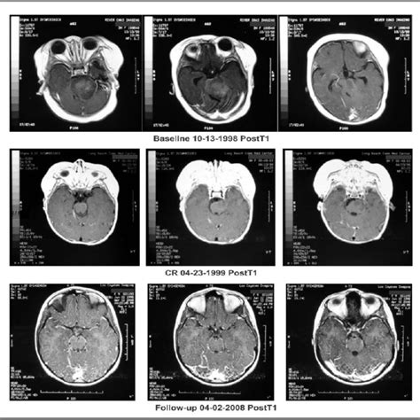 Axial Brain Magnetic Resonance Imaging Mri Post Contrast T1