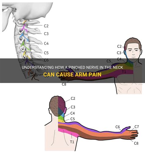 Understanding How A Pinched Nerve In The Neck Can Cause Arm Pain Medshun