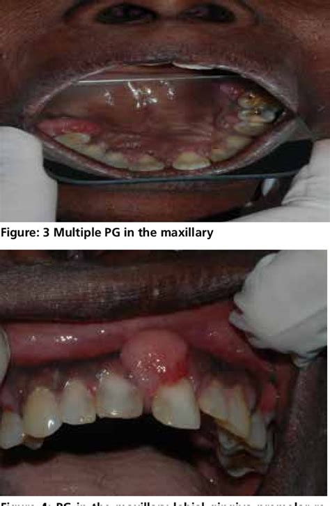 Figure 3 From Intra Oral Multiple Pyogenic Granuloma A Rare Case