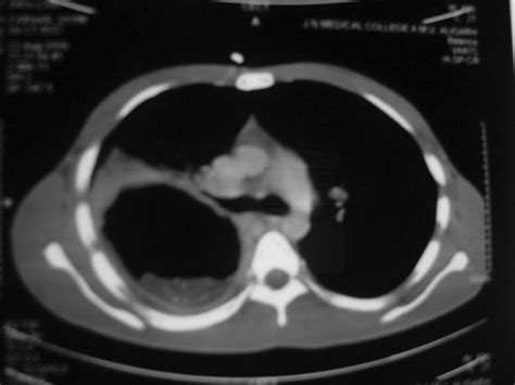 Ruptured Pulmonary Hydatid Cyst With Anaphylactic Shock And
