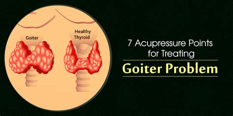 7 Acupressure Points For Treating Causes And Symptoms Of Goiter Problem