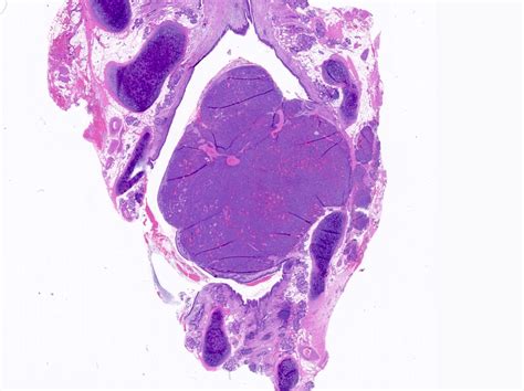 Pathology Outlines Typical Carcinoid Tumor Neuroendocrine Tumor