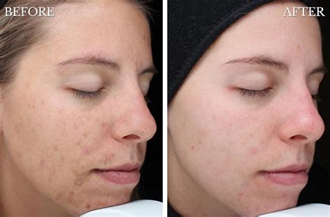 Acne Scars Before And After Chemical Peel