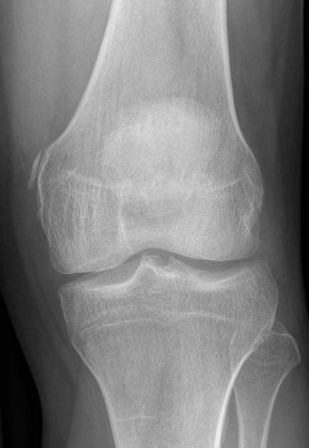 #foamed #foamrad #radiology #rad #elearnrad #voxelz #varunbabu #drbabu. Pellegrini-Stieda disease | Radiology Case | Radiopaedia.org