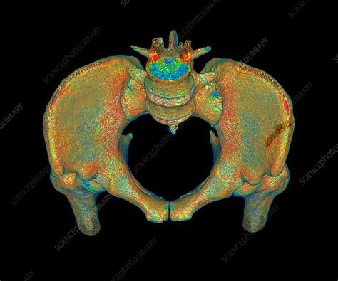 Female Pelvis 3d Ct Scan Stock Image C0360502 Science Photo Library