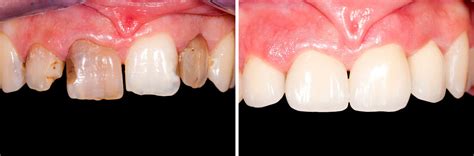 If your teeth are only slightly crooked, dentists can shape the veneers to make your teeth look straight. How To Fix Crooked Teeth With Veneers Beverly Hills, CA