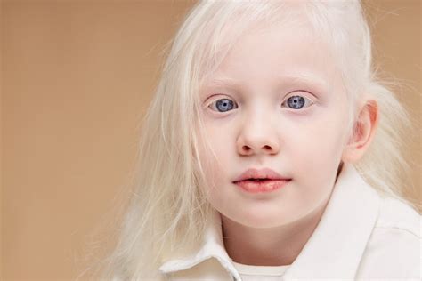 Comment Prendre Soin De La Peau Dun Enfant Albinos