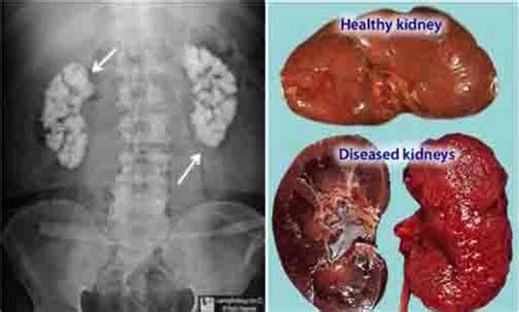 Chronic kidney disease (ckd) is a type of kidney disease in which there is gradual loss of kidney function over a period of months to years. Kidney Failure How To Cure - Kidney Failure Disease