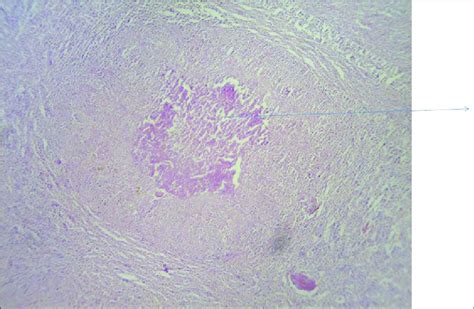 Histopathology Of Spleen Showing Caseation Granuloma Download