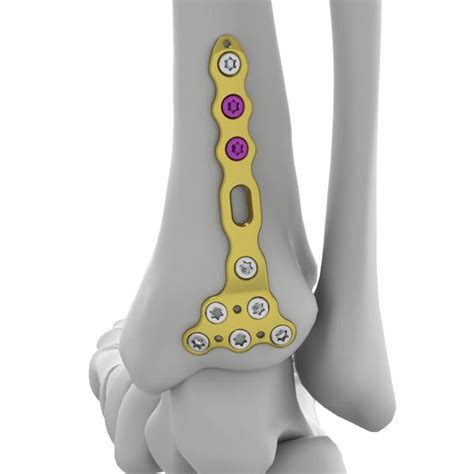 Distal Posterior Tibial Locking Plate Nxtmed