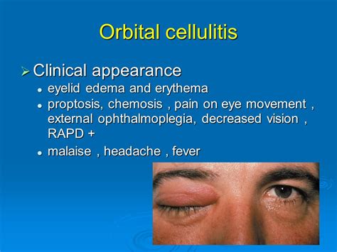 Cellulitis Symptoms Nose The Request Could Not Be Satisfied