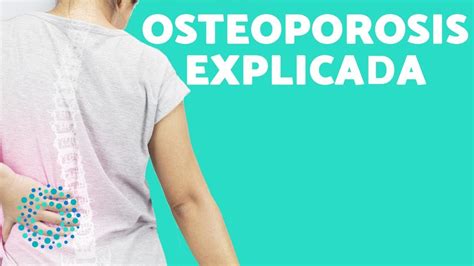 Qué Es La Osteoporosis 🦴 Síntomas Y Causas De La Osteoporosis Gema