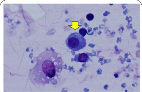 The Cytology Showed Activated Mesothelial Cells And