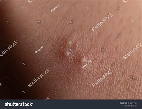 Skin Rash Blisters On Bodyinflamed Zit Stock Photo 2209727063