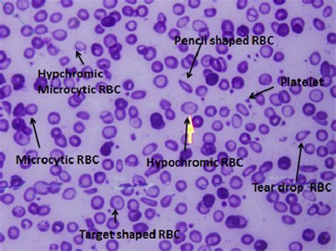 Peripheral Blood Film With Changes Attributed To Iron Deficiency Anemia