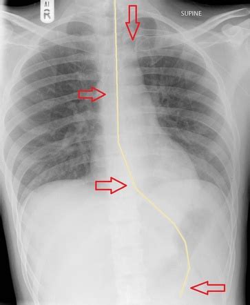 Nasogastric Tube Position On Chest X Ray Summary Radiology