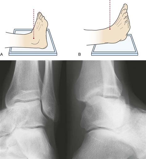 Imaging Of The Foot And Ankle Musculoskeletal Key