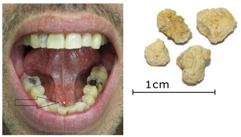 Blocked Salivary Gland Under Tongue