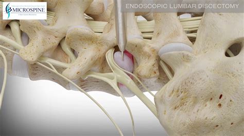 Endoscopic Lumbar Discectomy YouTube