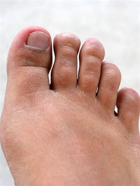 How To Decrease The Swelling With An Infected Toe