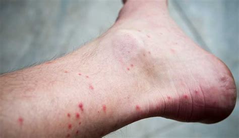 Flea Bites What They Look Like Symptoms Treatment