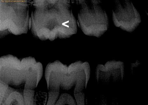 What Does A Cavity Look Like 1311 Jackson Ave Dental Dentist In