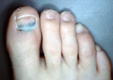 Maybe you would like to learn more about one of these? growth on toe - pictures, photos