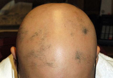 Alopecia Totalis Pictures Symptoms Causes Treatment Healthmd