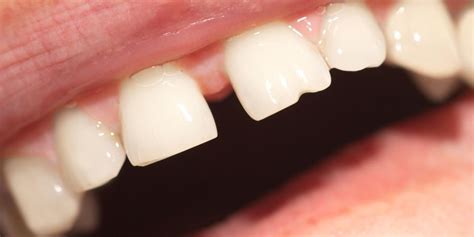 How To Identify And Manage Cracked Teeth Stafford Dental Associates Llc