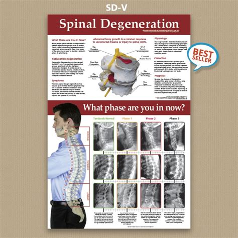 Spinal Degeneration Poster Chiropractic Posters