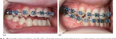 Figure From A Clinical Strategy For Maxillary Molar Intrusion Using Orthodontic Miniimplants