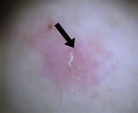Digital Photography In The Diagnosis Of Scabies Journal Of The