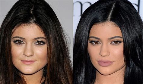 Kylie Jenner Before And After A Series Of Plastic Surgery