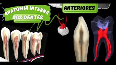 Anatomia Interna Dos Dentes Anteriores Endodontia Youtube