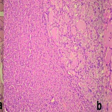 A Noninvasive Follicular Thyroid Neoplasm With Papillary Like Nuclear