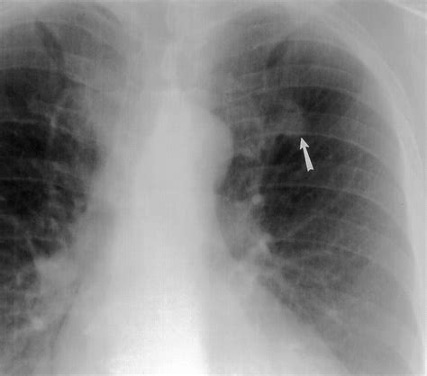 Solitary Pulmonary Nodules Part I Morphologic Evaluation For