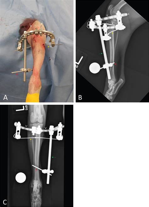 Use Of A Hybrid External Skeletal Fixator Construct For Managing Tibial