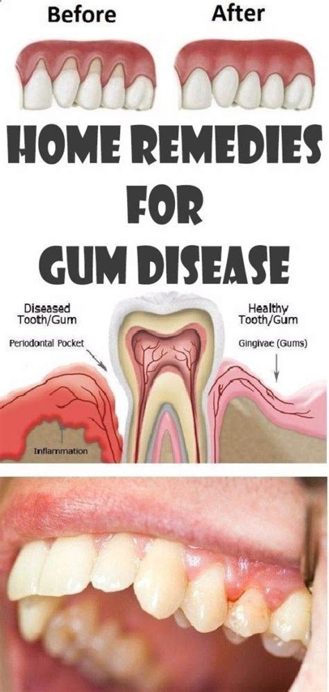 Home Remedies For Gum Disease Health Beauty Teeth Care Gum