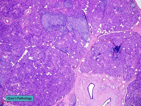 Qiaos Pathology Chronic Obstructive Sialadenitis Of The Submandibular