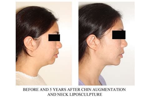 Neck Liposuction With Chin Implant Cosmetic Surgery Tips