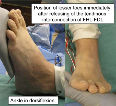 The Medial Longitudinal Skin Incision A And Intra Operative Finding