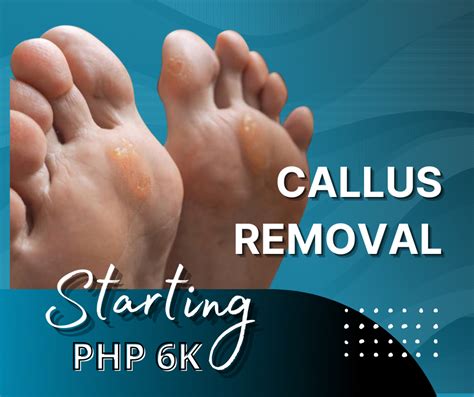 Callus Removal Dermatology