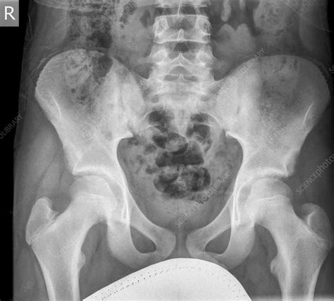 pelvis x ray stock image c019 7257 science photo library