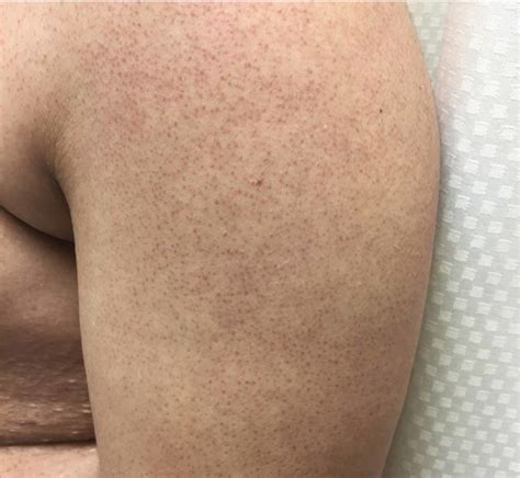 Cureus Hidradenitis Suppurativa In A Patient With Smith Magenis