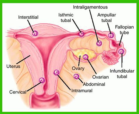 Kebanyakan kes kehamilan ektopik berlaku dalam tiub fallopian. SIGN OF PREGNANCY OUTSIDE THE UTERUS | Benefitsofahealthy