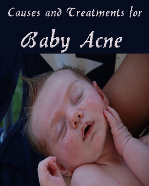 Causes And Treatments For Baby Acne
