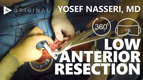Lower Anterior Resection For Rectal Cancer Dr Yosef Nasseri Youtube