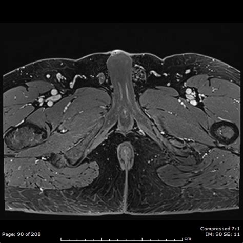 Penile Mondor Disease Dorsal Penile Vein Thrombophlebitis Image