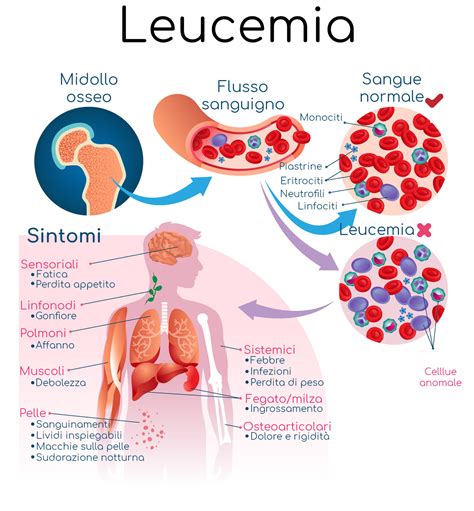 Leucemia Acuta E Cronica Sintomi E Cure Delle Diverse Forme