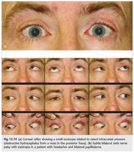 Neuro Ophthalmology Illustrated Chapter Th Nerve Palsy Neuro Ophthalmology